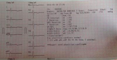 ECG