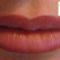 relleno-de-labios