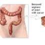 Colon Surgery