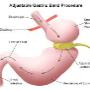 Lap Band Surgery