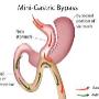 Mini Gastric Bypass Mexico