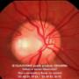 GLAUCOMA