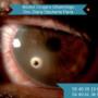 Rebaba ocular