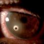 Rebabas oculares
