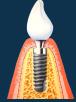 Implantes Dentales