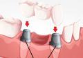 Implantes-Dentales