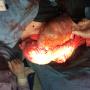Subido por visitante en 11/07/2016 - Liposarcoma retroperitoneal