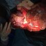Subido por visitante en 11/07/2016 - Liposarcoma