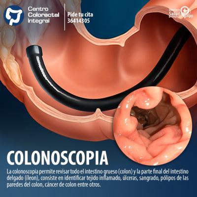 COLONOSCOPIA