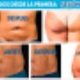 liposuccion sin cirugia1
