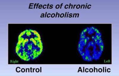 CEREBRO-DEL-ALCOHOLICO