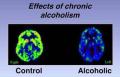 EL CEREBRO DEL ALCOHOLICO