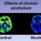 CEREBRO-DEL-ALCOHOLICO