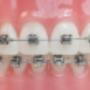 Brackets Autoligables