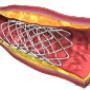 Subido por visitante en 04/04/2017 - Cateterismo Cardiaco STENT