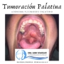 ADENOMA PALADAR