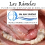 RANULA EN NIÑOS