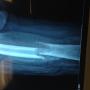 Fractura