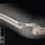 Fracturas