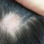 Elimina la Alopecia Areata
