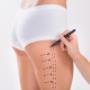 liposuccion en merida