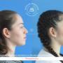 Rinoplastia en Monterrey