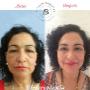 blefaroplastia