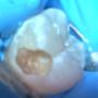Subido por visitante en 18/02/2018 - Caries en permanente 1-