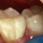 Subido por visitante en 18/02/2018 - Remoción d caries en permanente 1- con resina compuesta