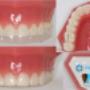 Subido por visitante en 01/08/2018 - INVISALIGN ORTODONCIA INVISIBLE