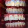 Subido por visitante en 07/05/2018 - Blanqueamiento dental en una cita