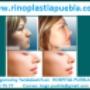 Rinoplastia Puebla