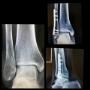 Fracturas de Tobillo