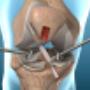 Artroscopia de Rodilla