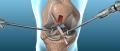 Artroscopia de Rodilla