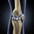 Prótesis de Rodilla
