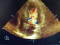Ecocardiograma