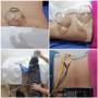 Cupping therapy