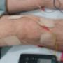 Electroterapia