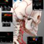 Ultrasonido arterial - prevención infarto cerebral