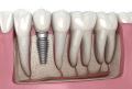 Implante dental