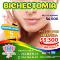 Bichectomia
