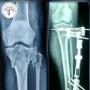 Fractura expuesta de tibia