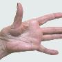 RIZARTROSIS DESGASTE EN LA ARTICULACIÓN DEL PULGAR