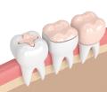 Resinas dentales
