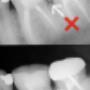 Ceramic crowns with sealed margins