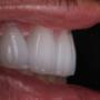 Dental Veneers with Natural and white aspects