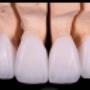 Dental veneers