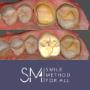 Digital Metal Free Crowns