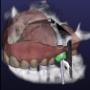 Digital implant surgery